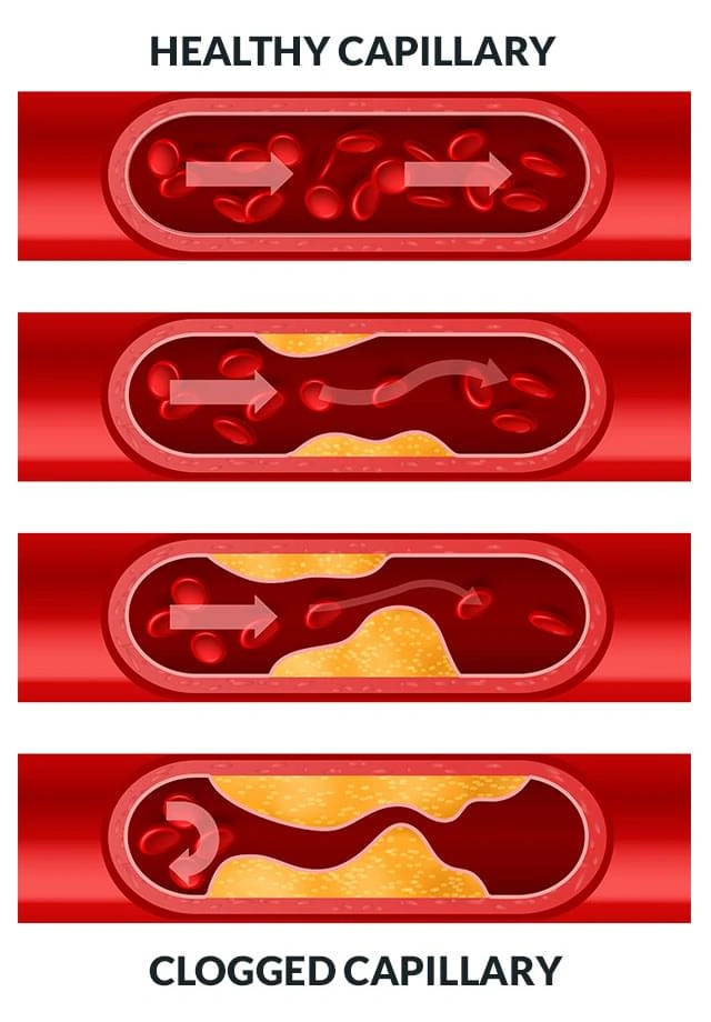 An illustration comparing a healthy capillary with a narrowed one