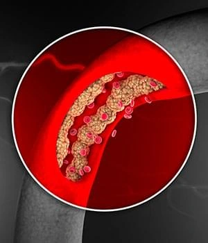 A render of a narrowed artery with plaque